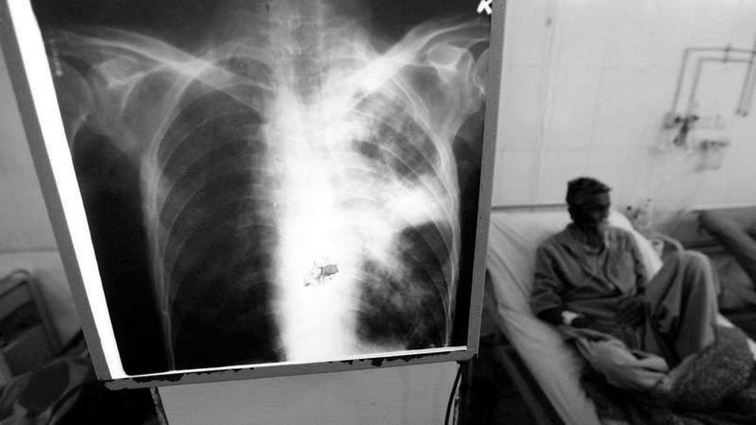 Hospital-tuberculosis-salud-EFE