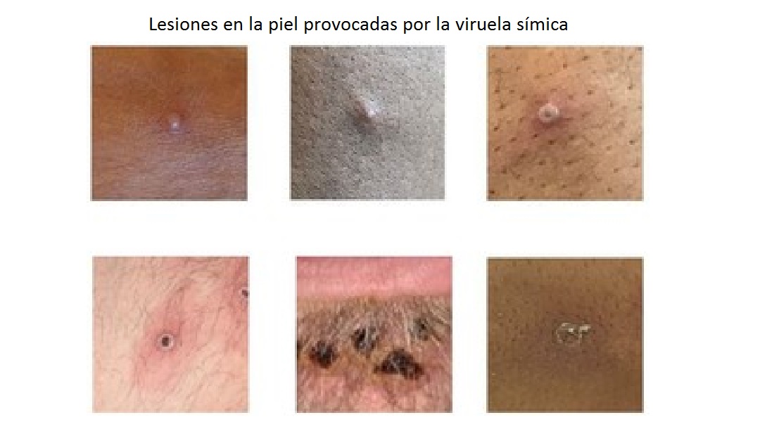 OMS-Emergencia-Salud-Pública-viruela-mono-Lesiones