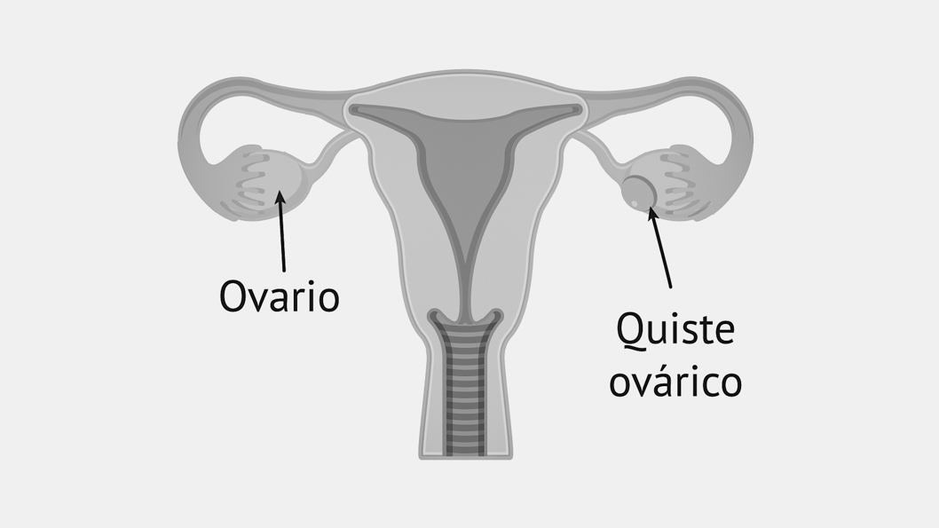 salud-sexual-no-reproductiva-quiste-ovarios-2